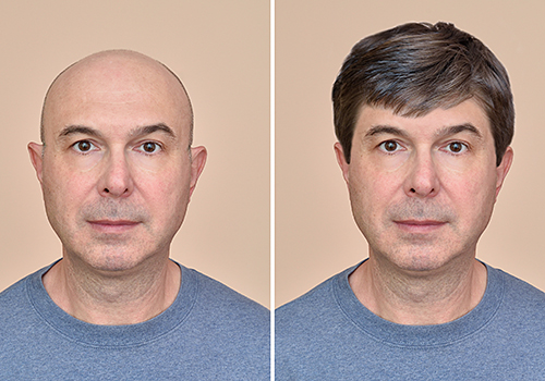 hair loss, man weave units, hair unit is non-invasive, hair unit is a non-surgical procedure